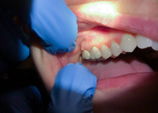 Best Emergency Tooth Extraction in Tuckahoe, VA