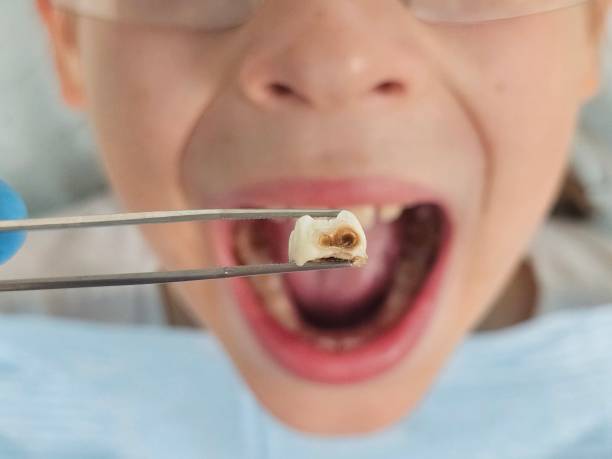 Best Emergency Treatment for Dental Infections or Abscesses in Tuckahoe, VA